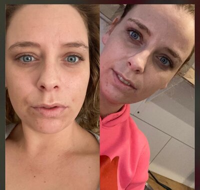 Links zonder protheses rechts met
