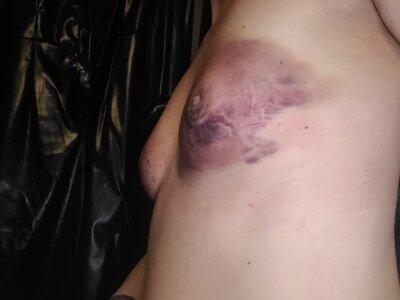 Rechterborst lipo