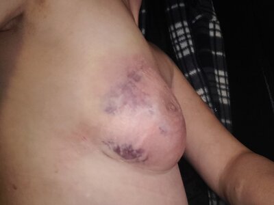 Linkerborst lipo