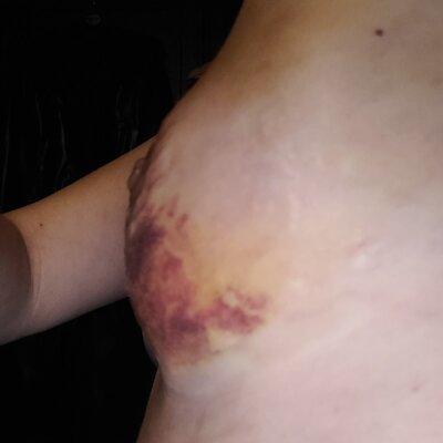 Rechterborst 250 cc 7 dagen na lipofilling