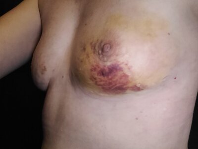 Zijaanzicht nu 7 dagen na lipofilling 220/250 cc