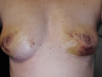 7 dagen ns lipofilling