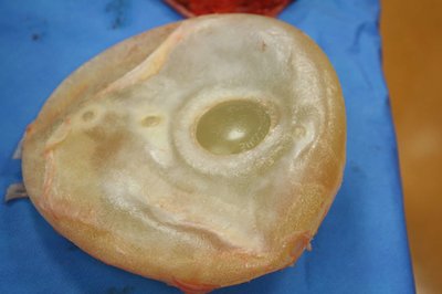 Franken 210861 implantaat+kapsel (5) (2020_01_13 11_30_08 UTC).JPG