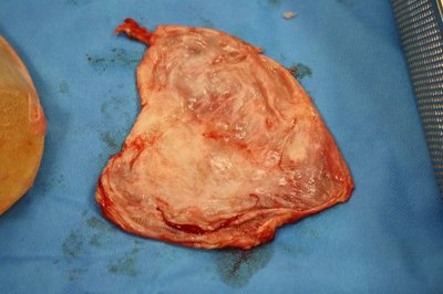 Franken 210861 implantaat+kapsel (6) (2020_01_13 11_30_08 UTC).JPG