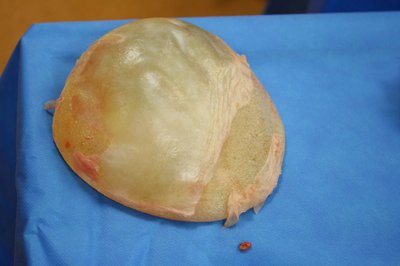 Franken 210861 implantaat+kapsel (3).JPG